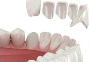 veneer